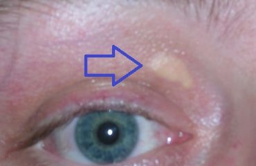 Xanthelasma_palpebrarum